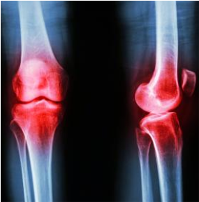 Dize Kök Hücre Tedavisi ile diz kireçlenmesine son!