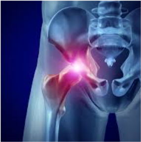Kök Hücre ile Kalça Kireçlenmesi Tedavisi