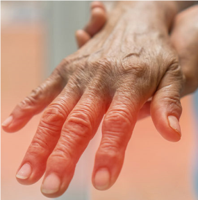 Romatoid Artrit Kök Hücre Tedavisi