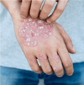 Sedef (Psöriazis) Hastalığında Kök Hücre ve Eksozom Tedavileri